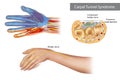 Carpal tunnel syndrome. Compressed median nerve. Anatomy of the carpal tunnel, showing the median nerve. Royalty Free Stock Photo