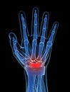 The Carpal Tunnel Syndrome