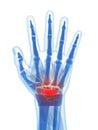 The carpal tunnel syndrome Royalty Free Stock Photo