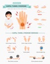 Carpal Tunnel Syndrome Infographic,illustration.