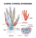 Carpal tunnel syndrome with median nerve pressure disease outline diagram Royalty Free Stock Photo