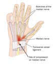 Carpal tunnel syndrome Royalty Free Stock Photo