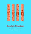 Cartoon Deep Vein Thrombosis Card Poster. Vector