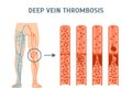 Cartoon Deep Vein Thrombosis Infographics Card Poster. Vector