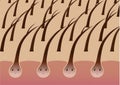 Cartoon hair follicles on the scalp suffering from split ends Royalty Free Stock Photo
