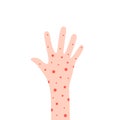 cartoon hand with rash like allergy