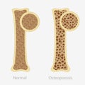 Cartoon human osteoporosis and normal healthy bone vector flat illustration