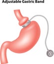 Cartoon illustration of Adjustable Gastric Band