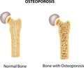 Cartoon illustration of bone of hip. normal bone and bone with osteoporosis