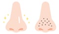 Cartoon illustration of clogged pores and clean pores on nose