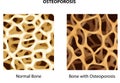 Cartoon illustration of normal bone and bone with osteoporosis