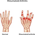 Cartoon Illustration of Rheumatoid Arthi