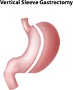 Cartoon illustration of vertical sleeve gastrectomy