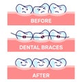 Cartoon kawaii funny teeth vector illustration, before and after brace correction. Concept of ortodontic treatment