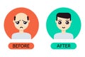 Cartoon man before and after hair transplantation