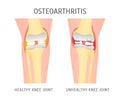 Cartoon Osteoarthritis Healthy and Unhealthy Knee. Vector