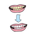 Cartoon before and after teeth bleaching or whitening treatment