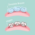 Cartoon tooth with invisible braces Royalty Free Stock Photo