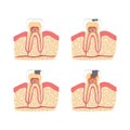 Cartoon Tooth with Stages of Dental Caries Formation Set. Vector
