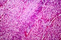 Caseation of human tuberculosis granuloma, light micrograph Royalty Free Stock Photo