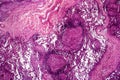 Caseous pneumonia, light micrograph Royalty Free Stock Photo