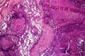 Caseous pneumonia, light micrograph Royalty Free Stock Photo