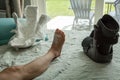 Cast removed from a foot after bunion surgery Royalty Free Stock Photo