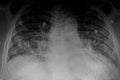 CAT Scan: Bilateral lung infection and right central venous catheter. Medical themes