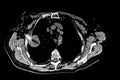 Cat Scan of the chest showing a fine needle transthoracic cytology aspiration of a lung tumor.