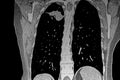 Cat Scan of frontal upper right lobe lung tumor.