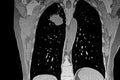 Cat Scan of frontal upper right lobe lung tumor.