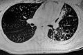 CAT Scan of young female with breast prosthesis and left upper lobe pulmonary tuberculosis.