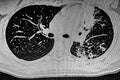 CAT Scan of young female with breast prosthesis and left upper lobe pulmonary tuberculosis.