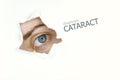 Cataract disease poster with  blue eye on left Royalty Free Stock Photo