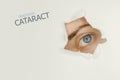 Cataract disease poster with blue eye on right. Royalty Free Stock Photo