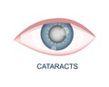 Cataract eye close up view. Eyeball with cloudy lens. Anatomically accurate human organ of vision with aging problems