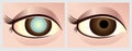 Cataract eye Royalty Free Stock Photo
