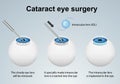 Cataract eye surgery process medical vector illustration isolated on grey background Royalty Free Stock Photo