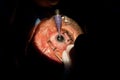 Cataract ophthalmologic surgery