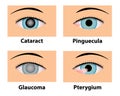 Cataract, Pinguecula, Glaucoma and Pterygium, eye care Royalty Free Stock Photo