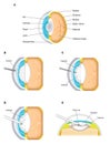 Cataract removal