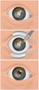 The eye's natural lens replaced with an artificial intraocular lens IOL . Cataract surgery, also called lens