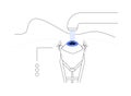 Cataract surgery procedure abstract concept vector illustration.