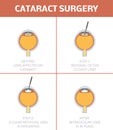 Cataract surgery,