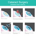 Cataract Surgery bladeless laser method.