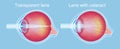 Cataracts and healthy eye detailed structure