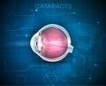 Cataracts, vision disorder