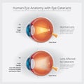 Cataracts Vision Disorder and Normal Eye Vision Anatomy