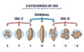 Categories of IBS stages according to bristol stool chart outline diagram