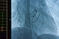 Catheter ablation for atrial fibrillation